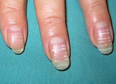 Alteraciones de las uñas
